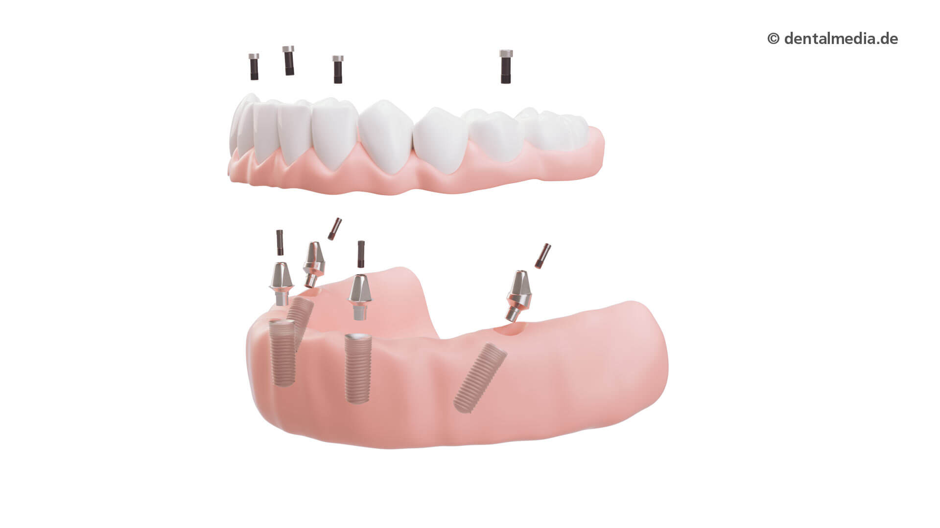 Vollprothese auf 4 Zahnimplantaten